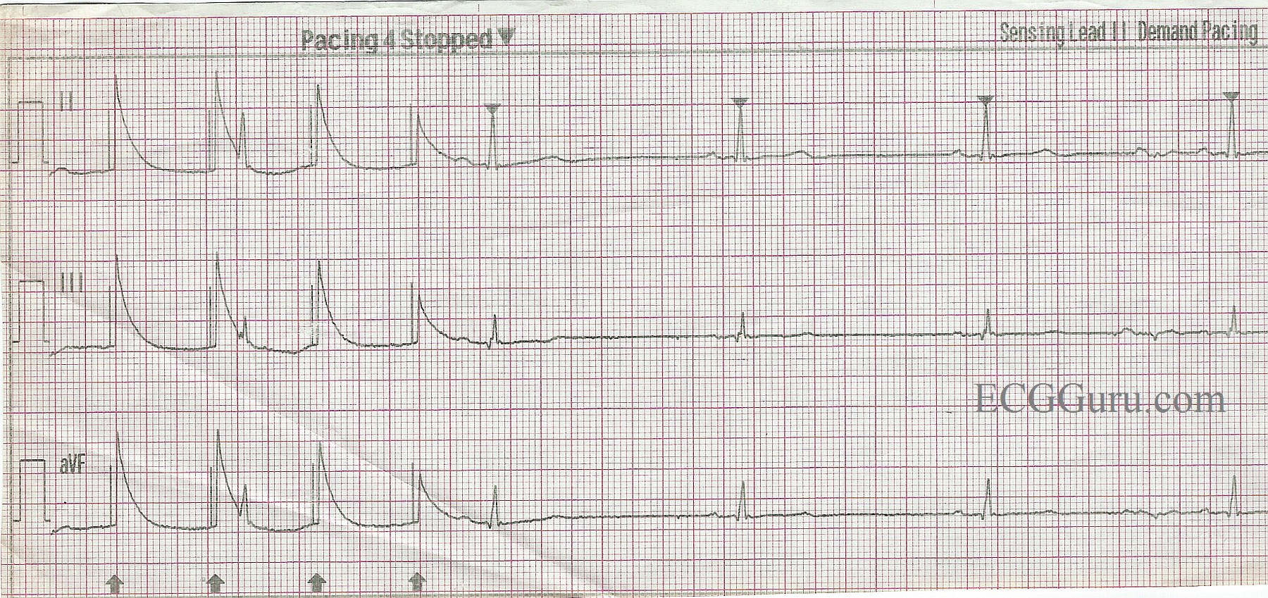 transcutaneous-pacemaker-failure-to-capture-and-false-qrs-artifact